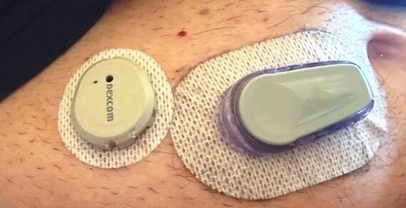 Usporedba Dexcom ONE Plus (lijevo) i Dexcom ONE (desno)